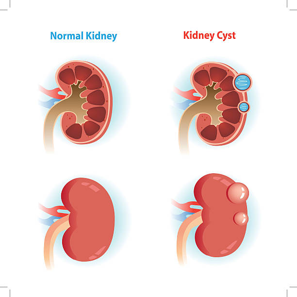 cisto renal 3
