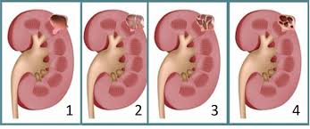 cistos nos rins 1