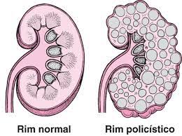 doença renal policistica